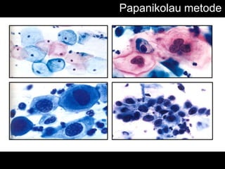 Papanikolau metode
 