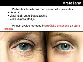 Pielietotas ārstēšanas metodes nosaka pacientes:
• Vecums
• Vispārējais veselības stāvoklis
• Vēţa klīniskā stadija
Pirmās izvēles metodes ir ķirurģiskā ārstēšana un staru
terapija.
Ārstēšana
 