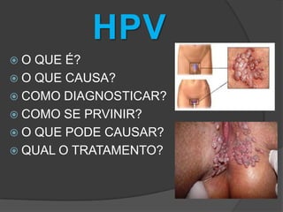 HPV
O

QUE É?
 O QUE CAUSA?
 COMO DIAGNOSTICAR?
 COMO SE PRVINIR?
 O QUE PODE CAUSAR?
 QUAL O TRATAMENTO?

 