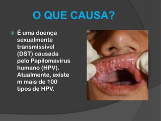 O QUE CAUSA?


É uma doença
sexualmente
transmissível
(DST) causada
pelo Papilomavírus
humano (HPV).
Atualmente, existe
m mais de 100
tipos de HPV.

 
