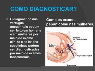 COMO DIAGNOSTICAR?


O diagnóstico das
verrugas
anogenitais podem
ser feito em homens
e em mulheres por
meio do exame
clínico e as lesões
subclínicas podem
ser diagnosticadas
por meio de exames
laboratoriais

Como os exame
papanicolau nas mulheres.

 