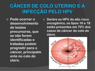 CÂNCER DE COLO UTERINO E A
INFECÇÃO PELO HPV


Pode ocorrer o
desenvolvimento
de lesões
precursoras, que
se não forem
identificadas e
tratadas podem
progredir para o
câncer, principalm
ente no colo do
útero.



Dentre os HPV de alto risco
oncogênico, os tipos 16 e 18
estão presentes em 70% dos
casos de câncer do colo do
útero.

 