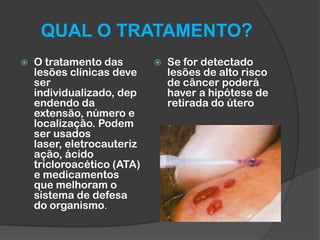 QUAL O TRATAMENTO?


O tratamento das
lesões clínicas deve
ser
individualizado, dep
endendo da
extensão, número e
localização. Podem
ser usados
laser, eletrocauteriz
ação, ácido
tricloroacético (ATA)
e medicamentos
que melhoram o
sistema de defesa
do organismo.



Se for detectado
lesões de alto risco
de câncer poderá
haver a hipótese de
retirada do útero

 