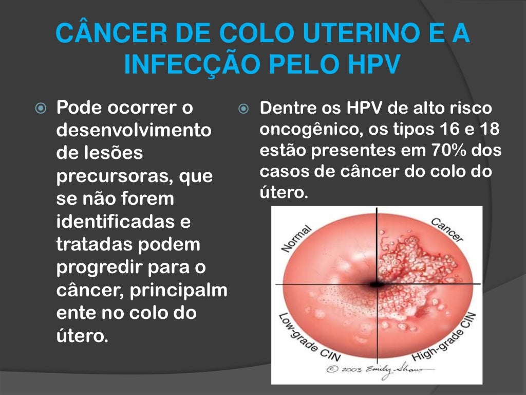 Verruga No Utero Fotos - NAZAEDU
