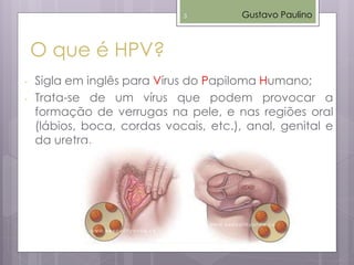 O que é HPV?
- Sigla em inglês para Vírus do Papiloma Humano;
- Trata-se de um vírus que podem provocar a
formação de verrugas na pele, e nas regiões oral
(lábios, boca, cordas vocais, etc.), anal, genital e
da uretra.
Gustavo Paulino3
 