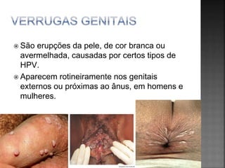  São erupções da pele, de cor branca ou
avermelhada, causadas por certos tipos de
HPV.
 Aparecem rotineiramente nos genitais
externos ou próximas ao ânus, em homens e
mulheres.
 