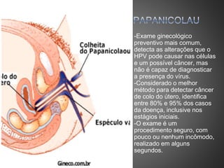 -Exame ginecológico
preventivo mais comum,
detecta as alterações que o
HPV pode causar nas células
e um possível câncer, mas
não é capaz de diagnosticar
a presença do vírus.
-Considerado o melhor
método para detectar câncer
de colo do útero, identifica
entre 80% e 95% dos casos
da doença, inclusive nos
estágios iniciais.
-O exame é um
procedimento seguro, com
pouco ou nenhum incômodo,
realizado em alguns
segundos.
 
