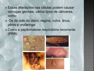  Essas alterações nas células podem causar
verrugas genitais, vários tipos de cânceres,
como:
 Os de colo do útero, vagina, vulva, ânus,
pênis e orofaringe:
 Como a papilomatose respiratória recorrente
(PRR).
 