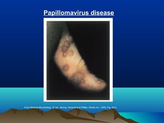 From Medical Microbiology, 5th
ed., Murray, Rosenthal & Pfaller, Mosby Inc., 2005, Fig. 52-4.
Papillomavirus disease
 