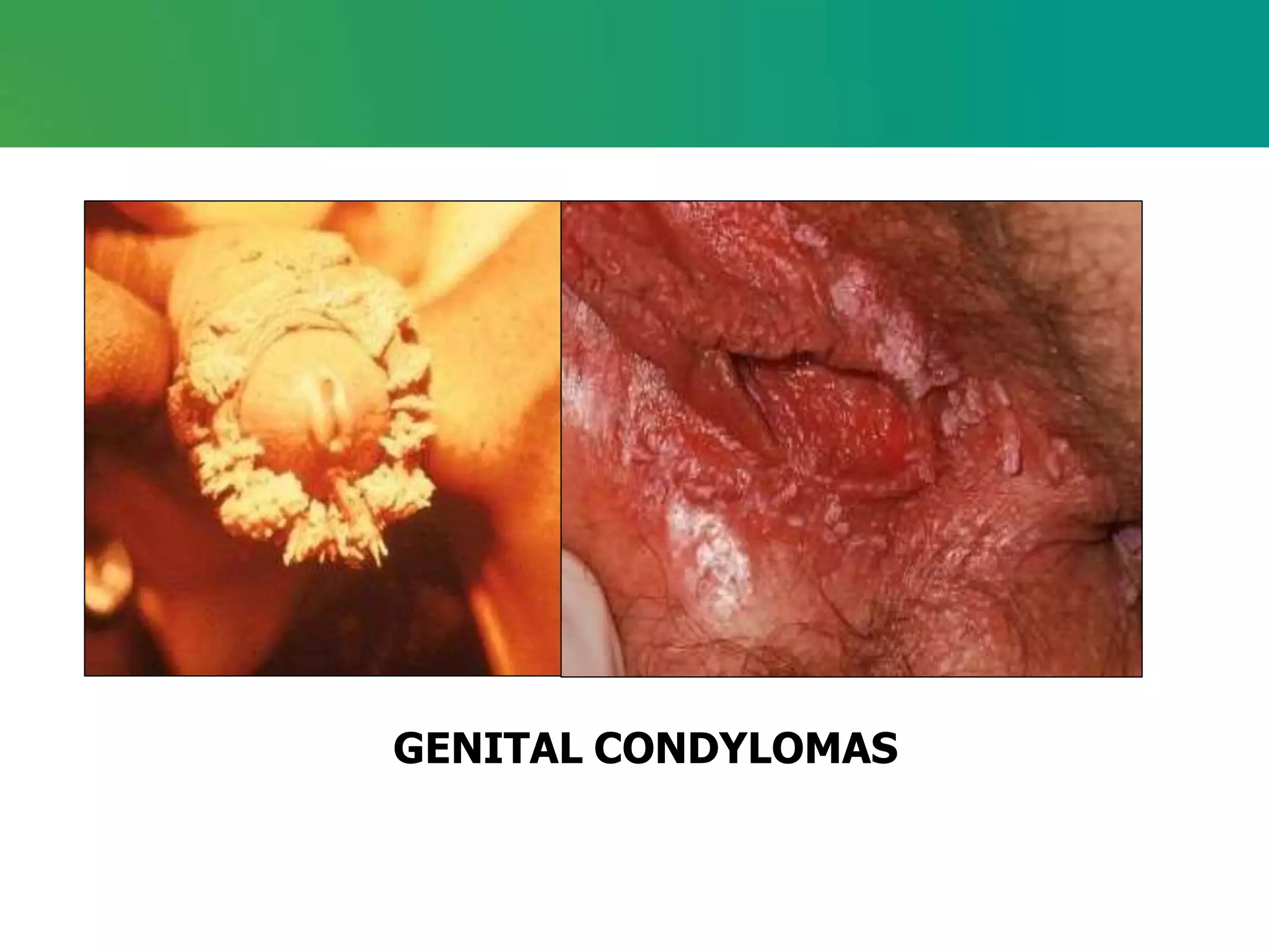 GENITAL CONDYLOMAS