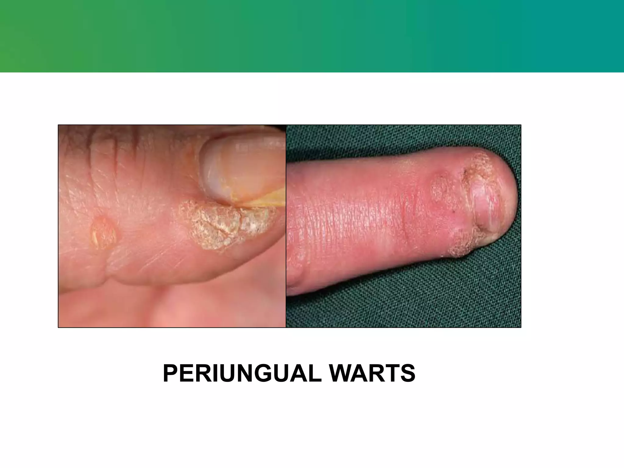 PERIUNGUAL WARTS