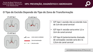 portaldeboaspraticas.iff.fiocruz.br
HPV: PREVENÇÃO, DIAGNÓSTICO E ABORDAGEM
O Tipo de Excisão Depende do Tipo de Zona de Transformação
• EZT tipo I: excisão não se estende mais
de 1cm do canal cervical
• EZT tipo II: excisão varia entre 1,5 e
2cm do canal cervical
• EZT tipo III (anteriormente chamada
de conização): excisão varia de 2 à
2,5cm do canal cervical
 