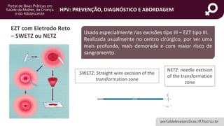 portaldeboaspraticas.iff.fiocruz.br
HPV: PREVENÇÃO, DIAGNÓSTICO E ABORDAGEM
EZT com Eletrodo Reto
– SWETZ ou NETZ
Usado especialmente nas excisões tipo III – EZT tipo III.
Realizada usualmente no centro cirúrgico, por ser uma
mais profunda, mais demorada e com maior risco de
sangramento.
SWETZ: Straight wire excision of the
transformation zone
NETZ: needle excision
of the transformation
zone
 
