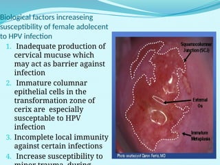 Human Papillomavirus (HPV) Role in Cervical Precancerous Lesions and ...