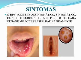 SINTOMAS
 O HPV PODE SER ASSINTOMÁTICO, SINTOMÁTICO,
CLÍNICO E SUBCLÍNICO. A DEPENDER DE CADA
ORGANISMO PODE SE ESPALHAR RAPIDAMENTE.
 