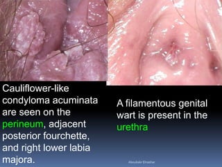 Genital warts management | PPT