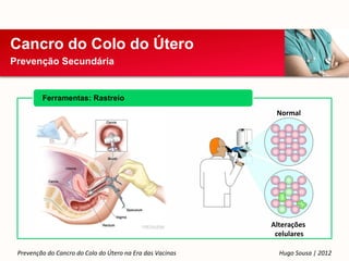 Cancro do Colo do Útero
Prevenção Secundária


         Ferramentas: Rastreio
                                                            Normal




                                                           Alterações
                                                            celulares

 Prevenção do Cancro do Colo do Útero na Era das Vacinas     Hugo Sousa | 2012
 