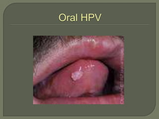 Oral HPV<br />