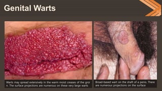 Definition Klassifikation offset Genital Warts(HPV), Genital Herpes