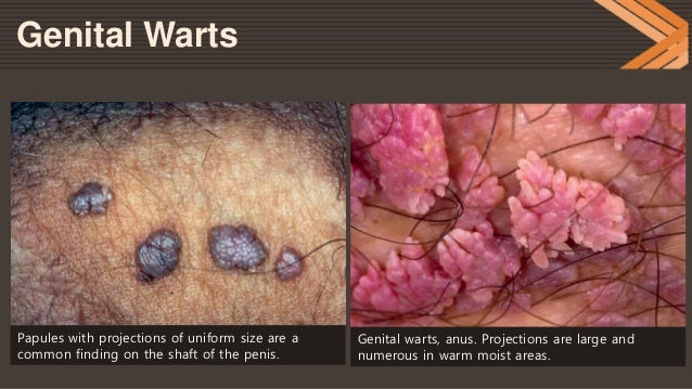 Genital Warts(HPV), Genital Herpes Genital Warts(HPV), Genital Herpes