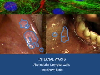 INTERNAL WARTS Also includes Laryngeal warts  (not shown here) 