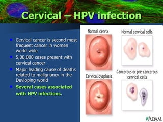 Cervical – HPV infection ,[object Object],[object Object],[object Object],[object Object]