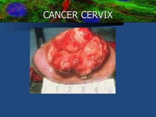 CANCER CERVIX 