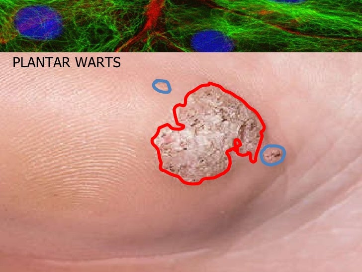 hpv oral infection for test INFECTION HUMAN 2010 PAPILLOMA VIRAL