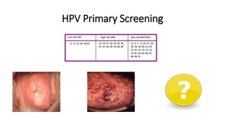 HPV Primary Screening
 