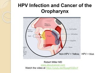 HPV Infection and Cancer of the
Oropharynx
Non-HPV = Yellow, HPV = blue
Robert Miller MD
www.aboutcancer.com
Watch the video at https://youtu.be/ISyagHODIvY
 