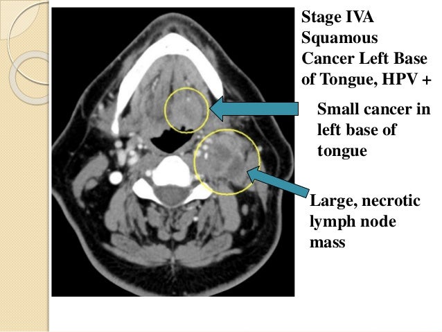 Hpv Base Of Tongue Cancer