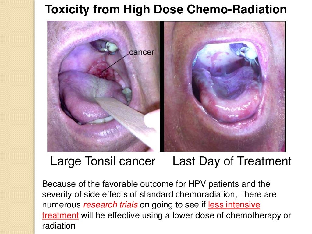 Hpv virus infections and oropharynx cancer