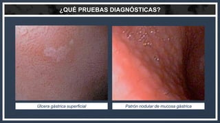 ¿QUÉ PRUEBAS DIAGNÓSTICAS?
Úlcera gástrica superficial Patrón nodular de mucosa gástrica
 