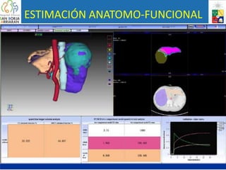 ESTIMACIÓN ANATOMO-FUNCIONAL
• ZHONG SYSTEM
• Software permite fusionar:
• Información obtenida por Tc GSA SPECT
• Información obtenida por Volumetría por TC
 
