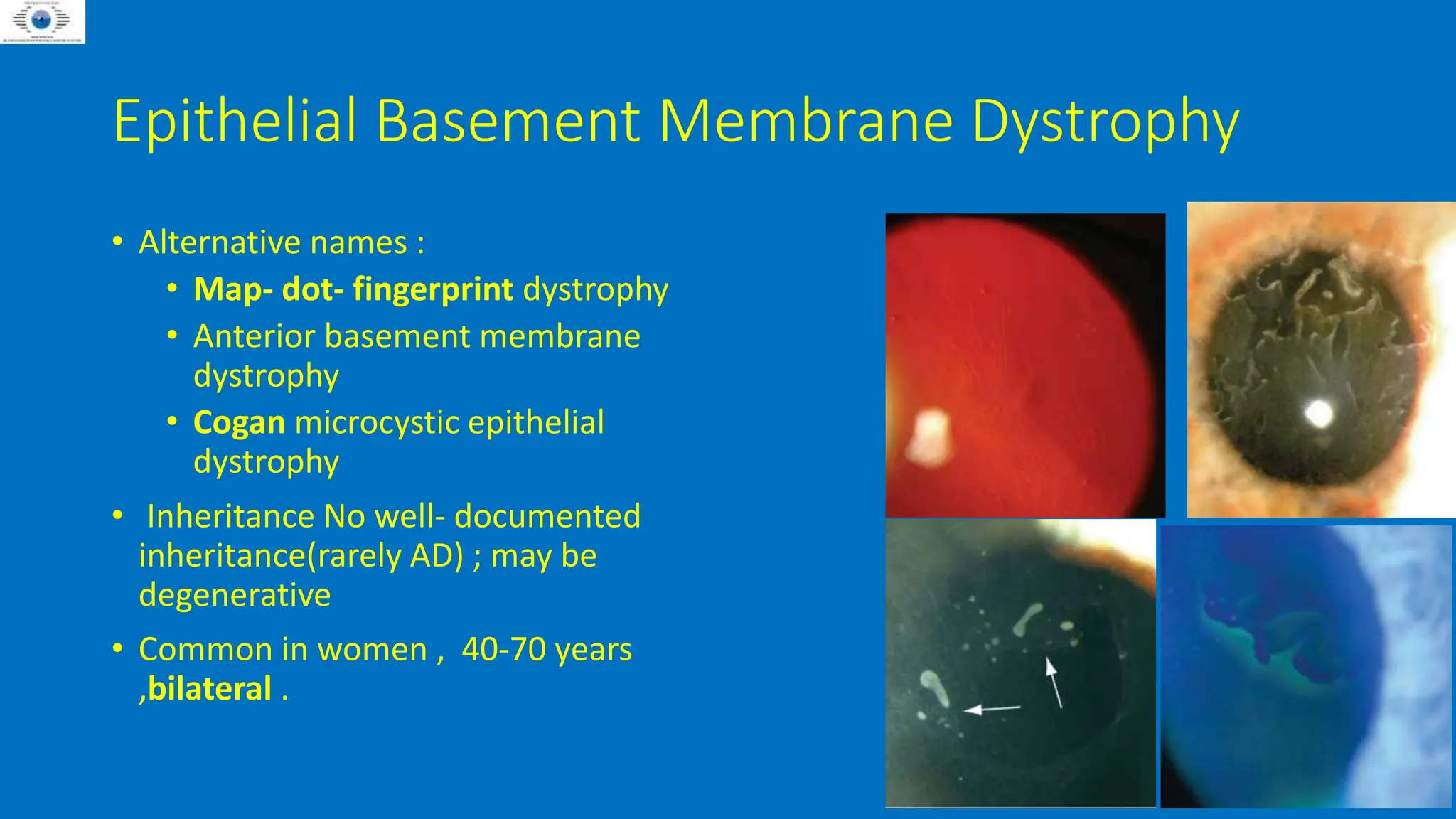 Bilateral Epithelial Basement Membrane Dystrophy