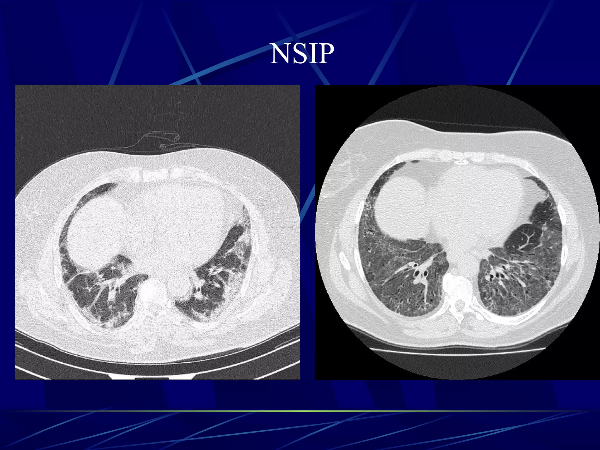 NSIP
 