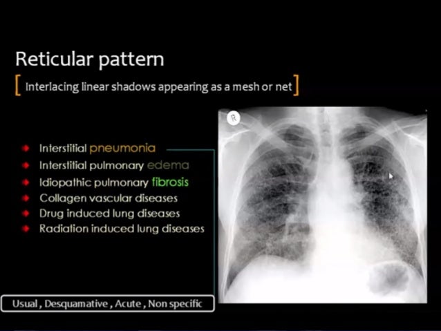 HRCT Reticular Pattern hrct-reticular-pattern
