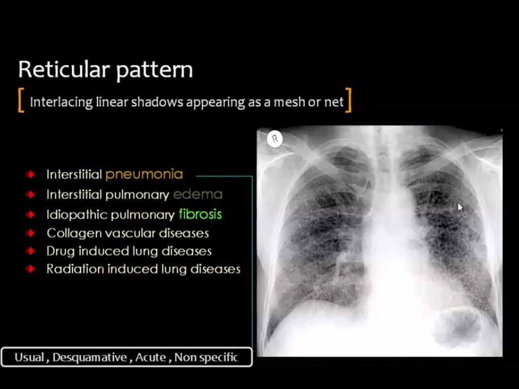Hrct reticular pattern
