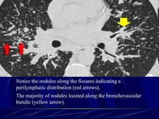 Notice the nodules along the fissures indicating a
perilymphatic distribution (red arrows).
The majority of nodules located along the bronchovascular
bundle (yellow arrow).
 