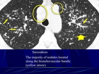 Sarcoidosis
The majority of nodules located
along the bronchovascular bundle
(yellow arrow).
 