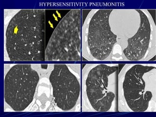 HYPERSENSITIVITY PNEUMONITIS
 