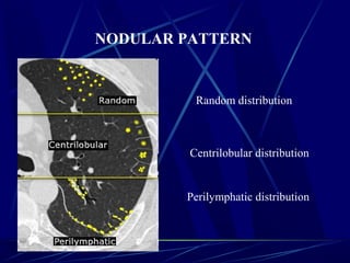 Perilymphatic distribution
Centrilobular distribution
Random distribution
NODULAR PATTERN
 