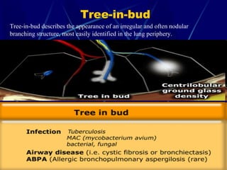Tree-in-bud
Tree-in-bud describes the appearance of an irregular and often nodular
branching structure, most easily identified in the lung periphery.
 