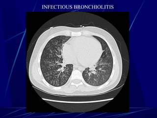 INFECTIOUS BRONCHIOLITIS
 