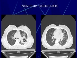 PULMONARY TUBERCULOSIS
 