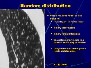 Random distribution
Small random nodules are
seen in:
 Hematogenous metastases
 Miliary tuberculosis
 Miliary fungal infections
 Sarcoidosis may mimic this
pattern, when very extensive
 Langerhans cell histiocytosis
(early nodular stage)
SILICOSIS
 