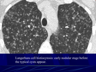 Langerhans cell histiocytosis: early nodular stage before
the typical cysts appear.
 