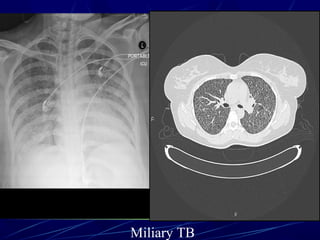 Miliary TB
 