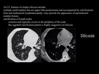 At CT, features of simple silicosis include:
multiple small nodules that are upper lobe predominant and accompanied by calcifications
hilar and mediastinal lymphadenopathy: may precede the appearance of parenchymal
nodular lesions
calcification of lymph nodes
common and typically occurs at the periphery of the node
this eggshell calcification pattern is highly suggestive of silicosis
 