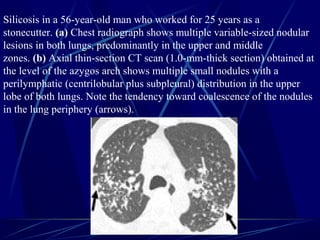 Silicosis in a 56-year-old man who worked for 25 years as a
stonecutter. (a) Chest radiograph shows multiple variable-sized nodular
lesions in both lungs, predominantly in the upper and middle
zones. (b) Axial thin-section CT scan (1.0-mm-thick section) obtained at
the level of the azygos arch shows multiple small nodules with a
perilymphatic (centrilobular plus subpleural) distribution in the upper
lobe of both lungs. Note the tendency toward coalescence of the nodules
in the lung periphery (arrows).
 